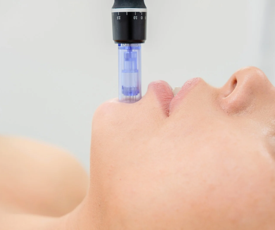 RF Microneedling