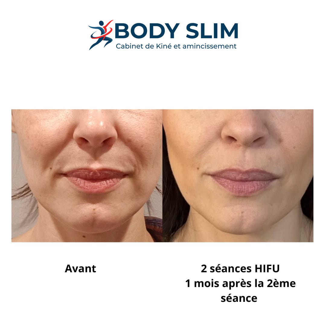 Résultat Avant Après Lifting HIFU - Visage et bas du visage
