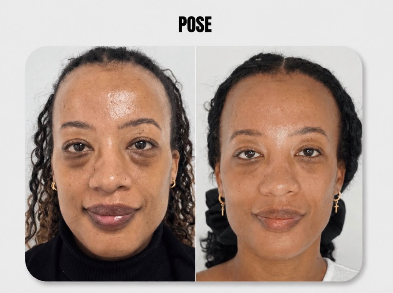 POSE AESTHETICS Bright Eyes Case 1: Frontal Profile