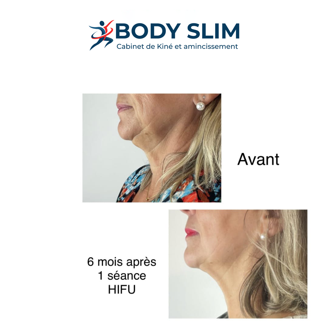 Résultat Avant Après - Ovale du visage et cou