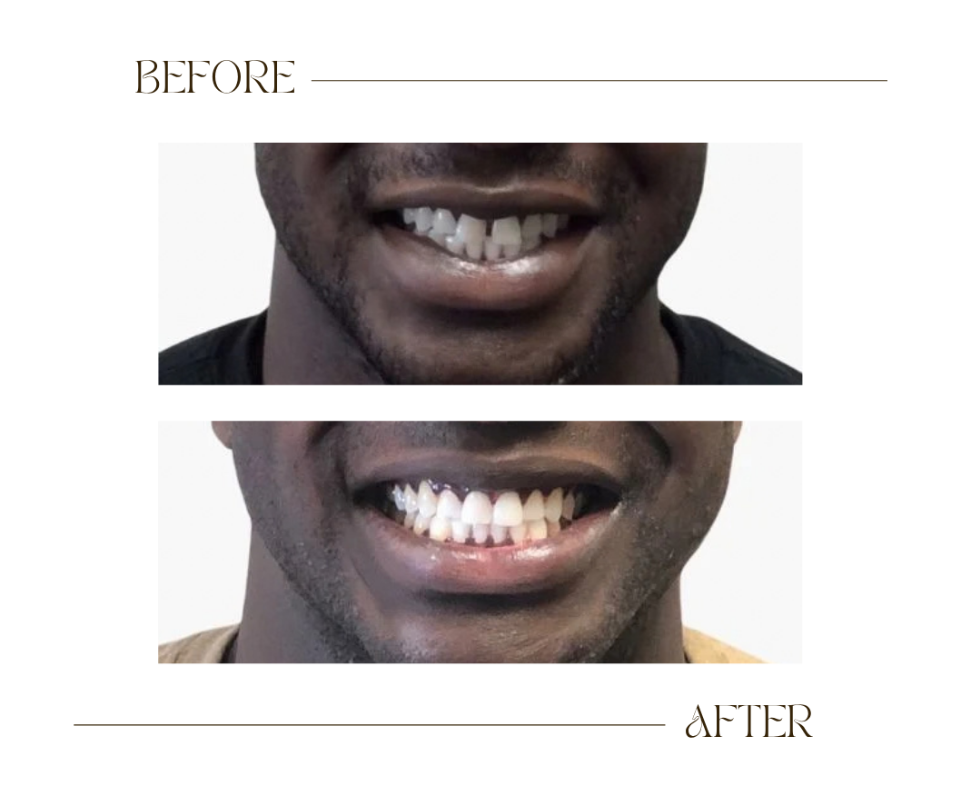 Dr Bee Inc Invisalign Before and After Case 3