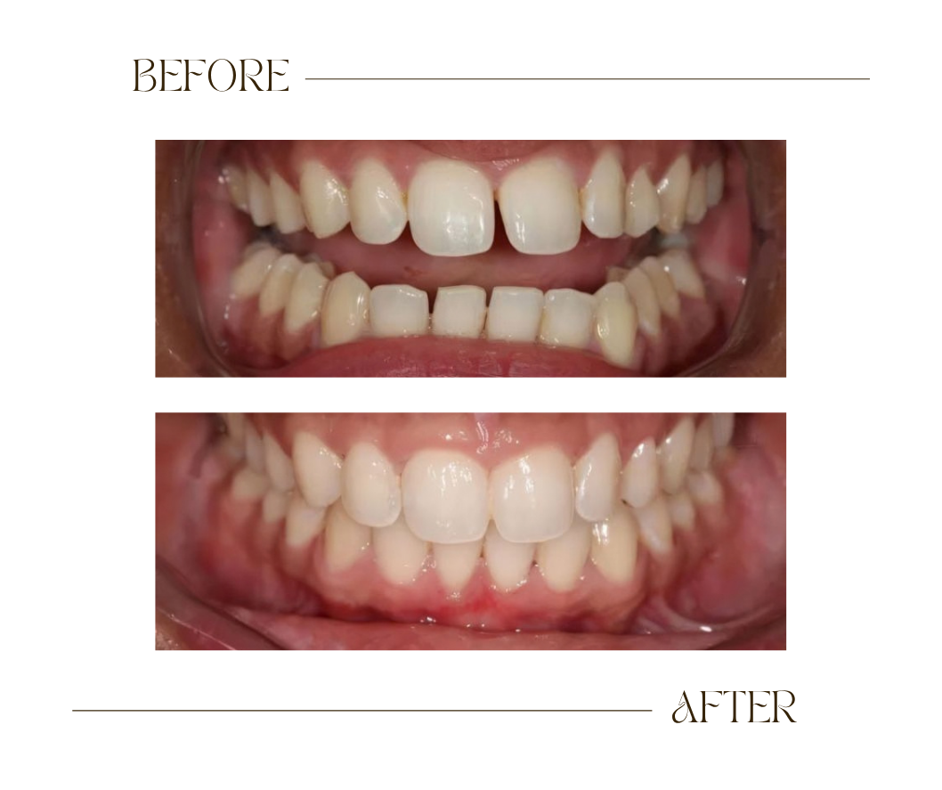 Dr Bee Inc Invisalign Before and After Case 1