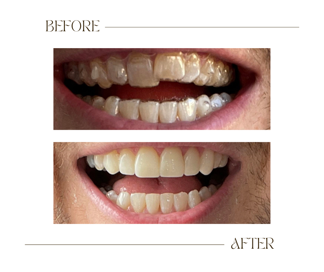 Dr Bee Inc Invisalign Before and After Case 2