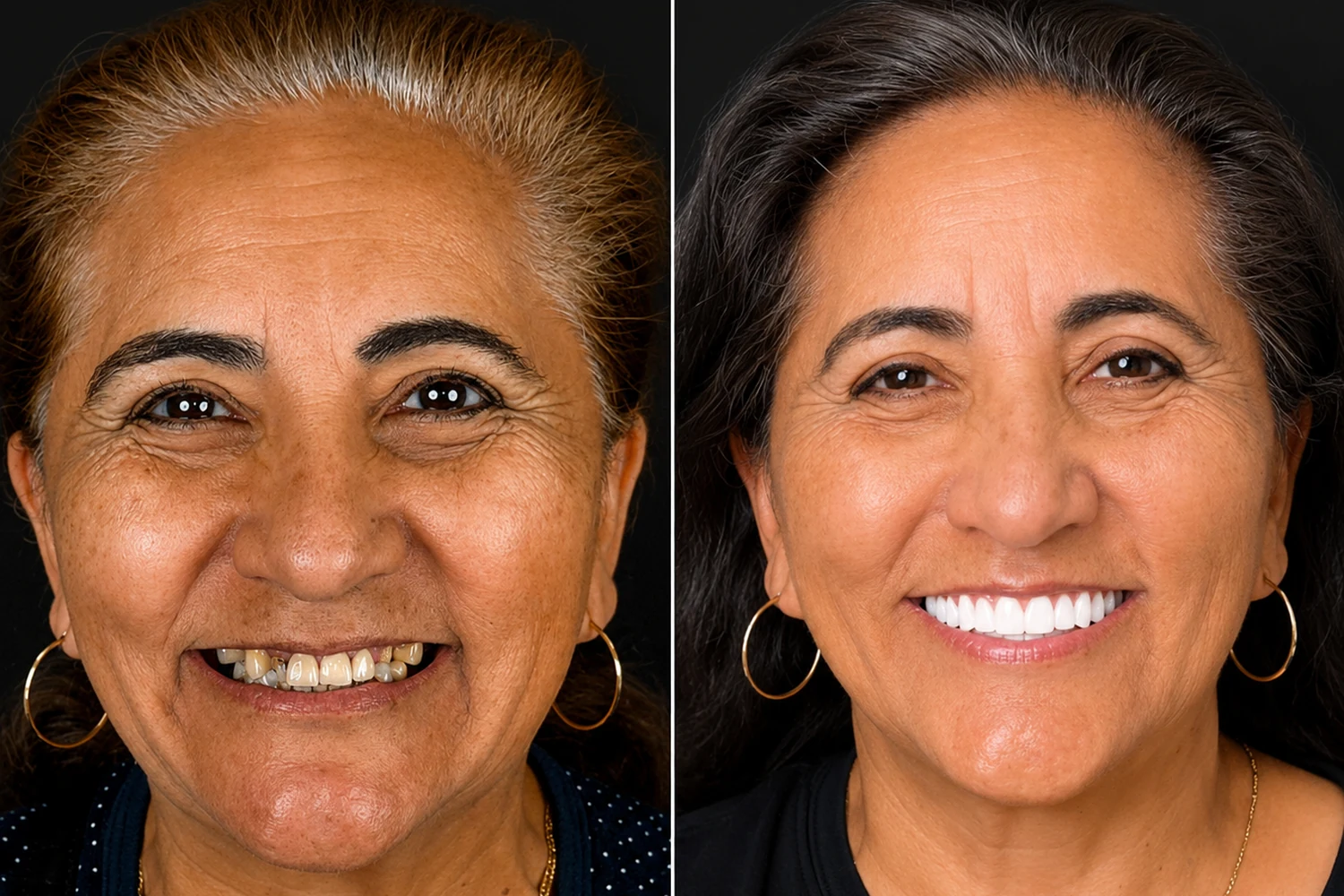 Real Pannu Dental Group All-on-X patient before and after – case 2