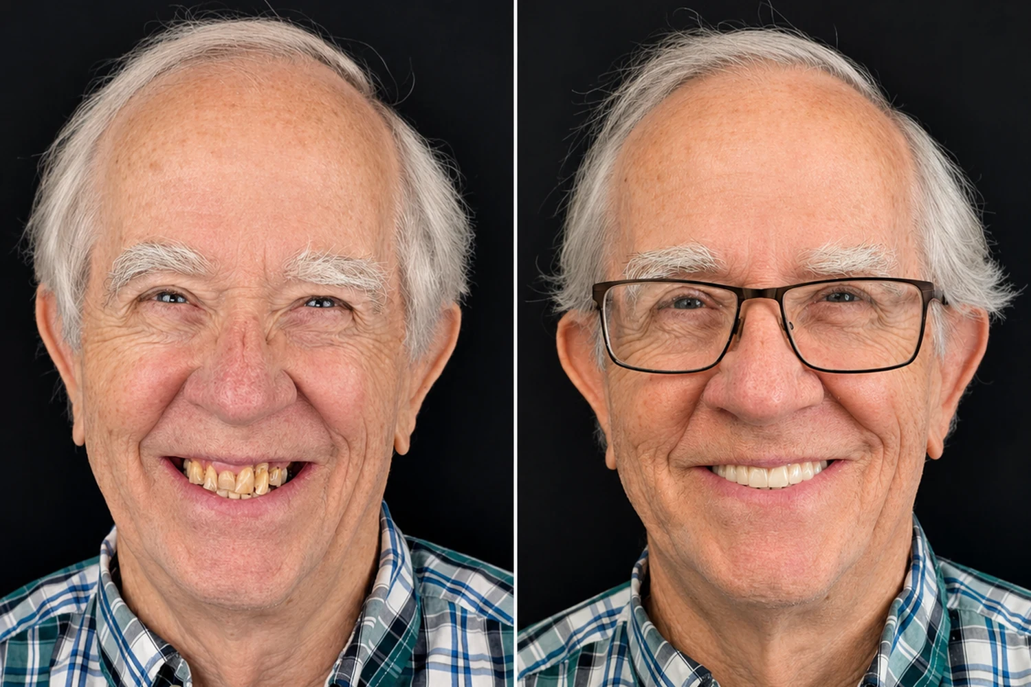 Real Pannu Dental Group All-on-X patient before and after – case 1
