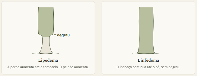 Esquema comparativo entre lipedema com degrau e linfedema sem degrau