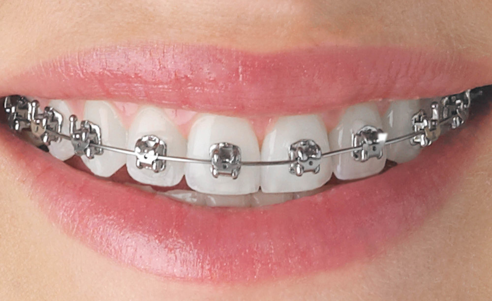 Brackets Autoligados Damon & Pitts 21