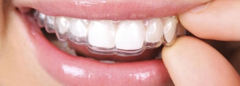 Ortodoncia Invisible (Invisalign)