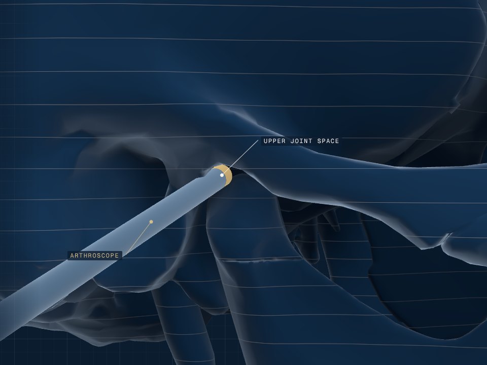 TMJ arthroscopy