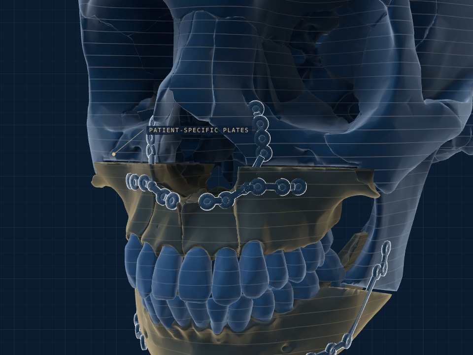 Virtual planning and patient-specific implants