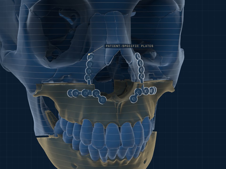 Minimally invasive orthognathic surgery