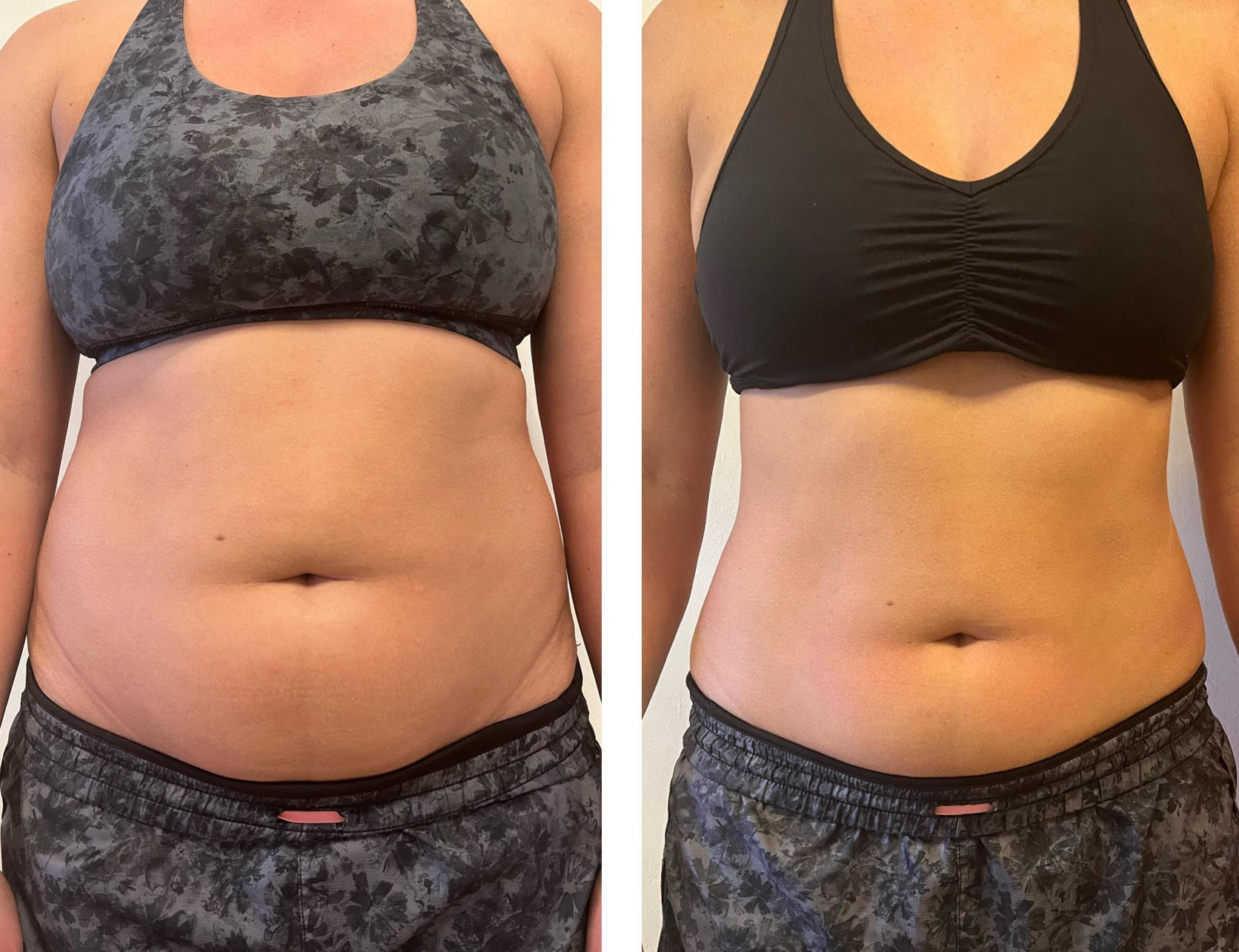 CryoSlimming before and after results on stomach and abdomen