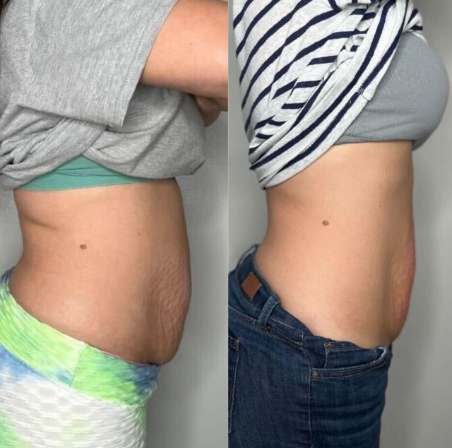CryoSlimming before and after profile results on stomach and lower belly