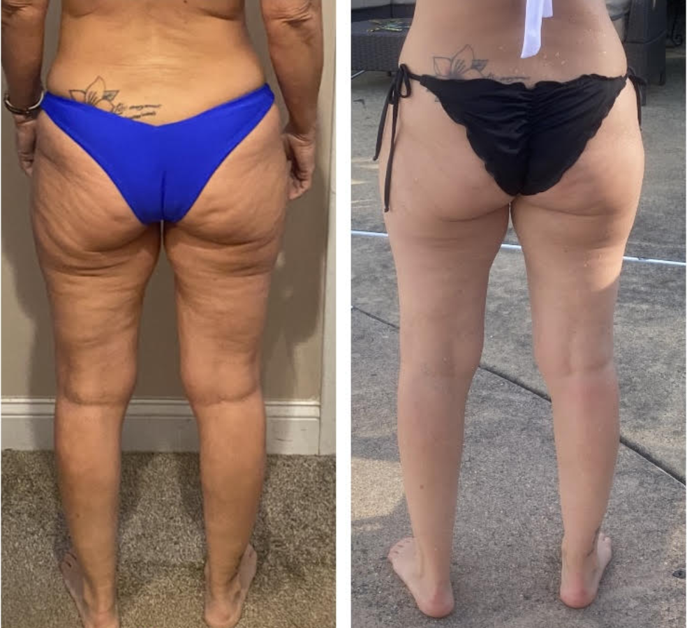 CryoSlimming and smoothing before and after results on thighs and glutes