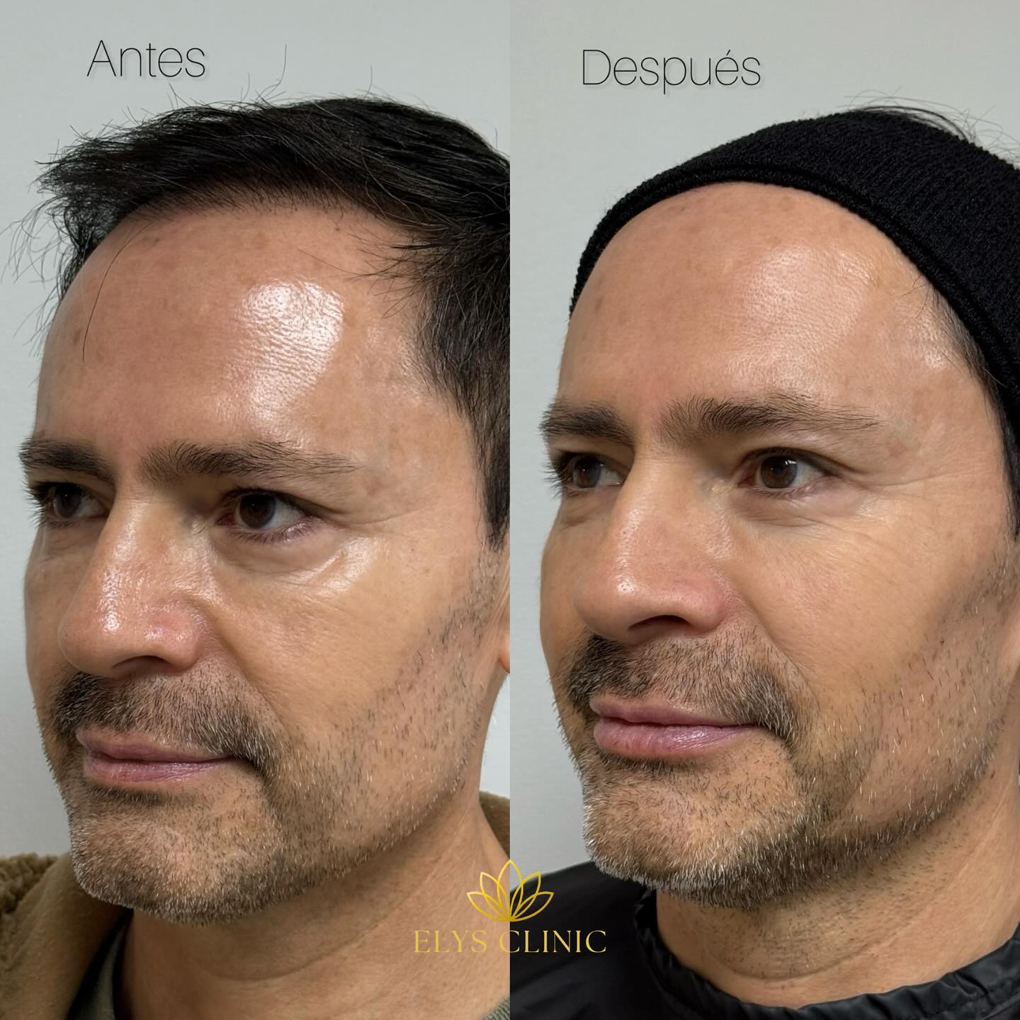 Antes y después · Bioestimulación y tercio superior masculino