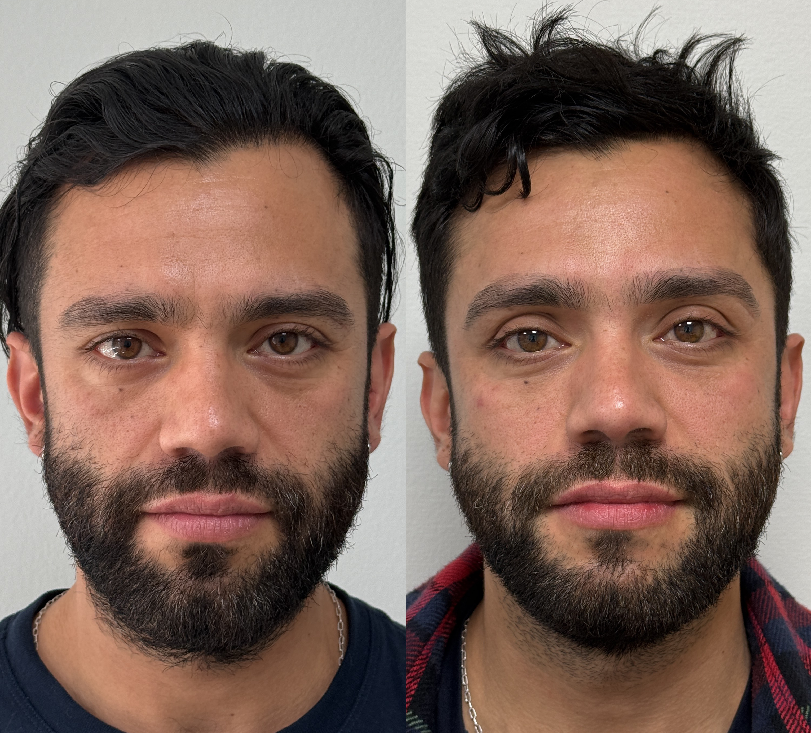 Antes y después · Tensado facial y papada con HIFU
