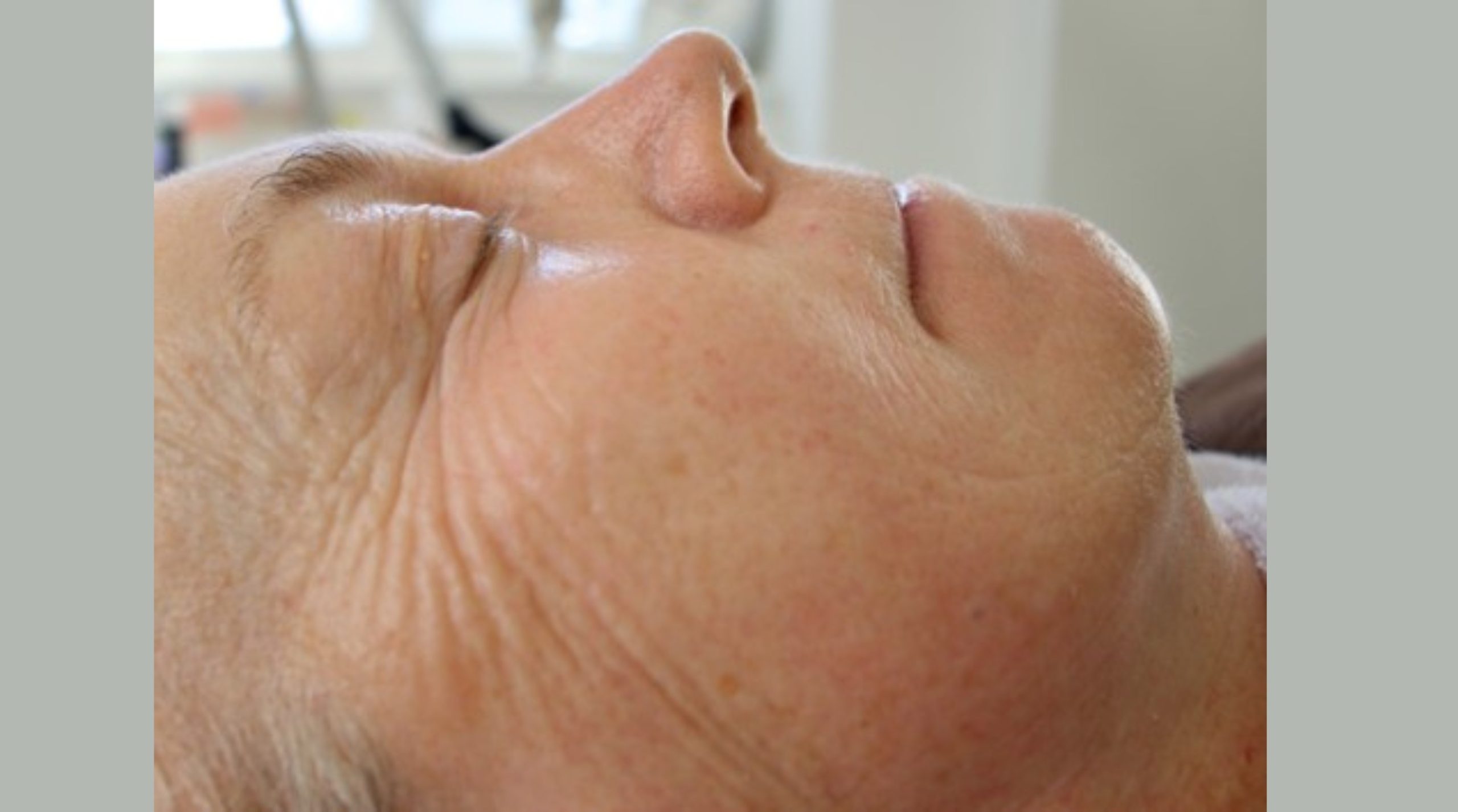 JetPeel clinical case after