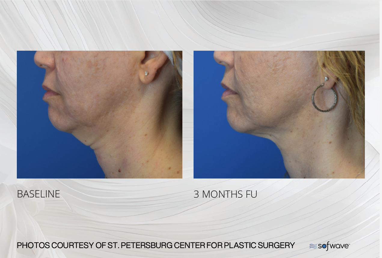Sofwave before and after tissue remodeling result