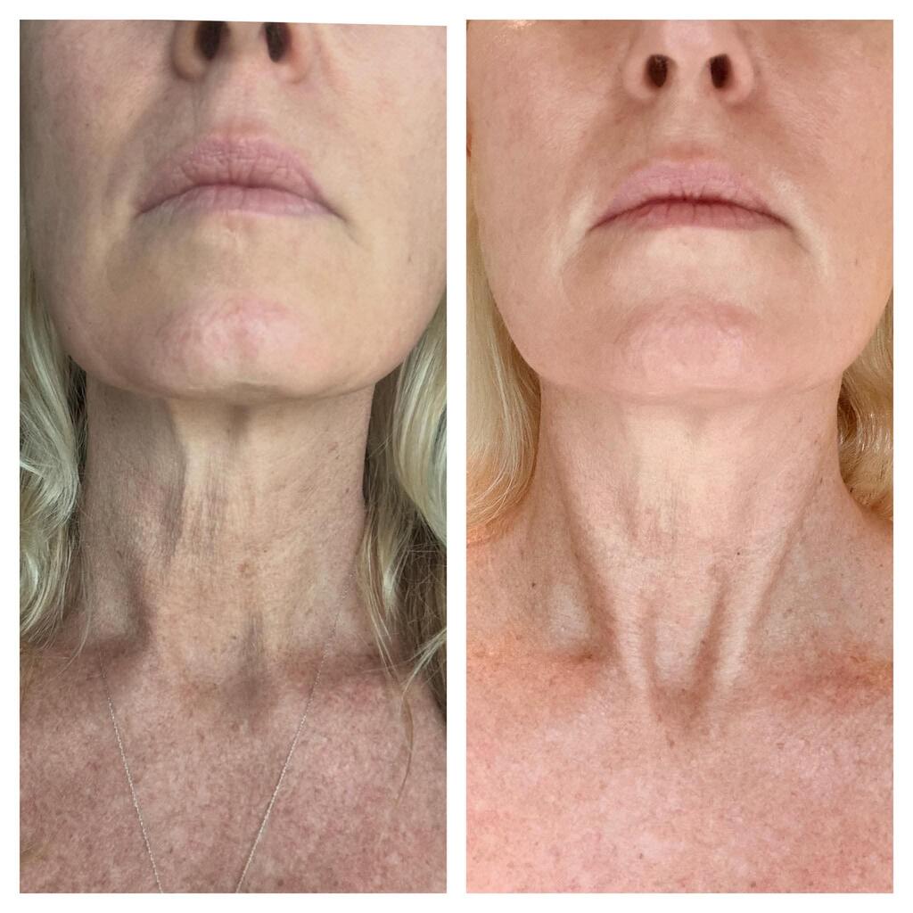 Submental & Anterior Cervical Banding Tightening