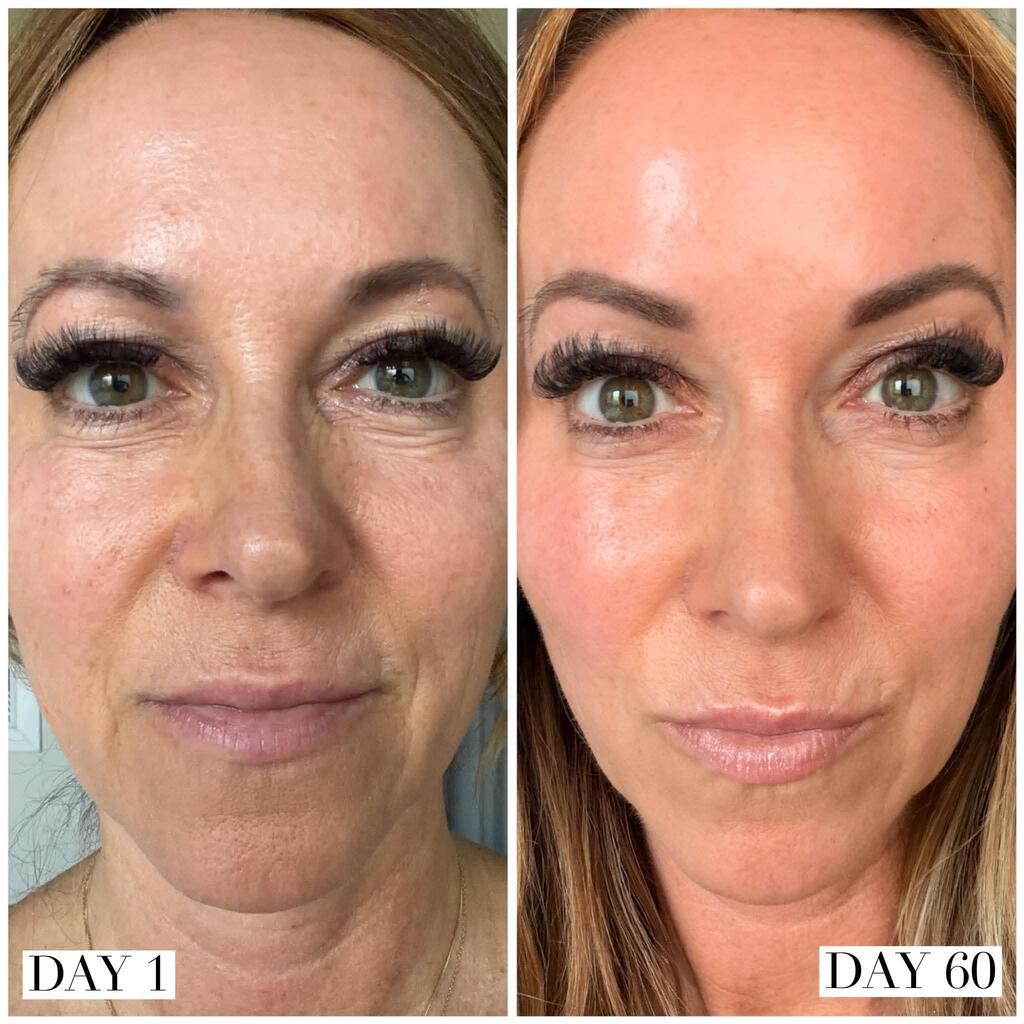 Full-Face Radiance & Periorbital Wrinkle Reduction