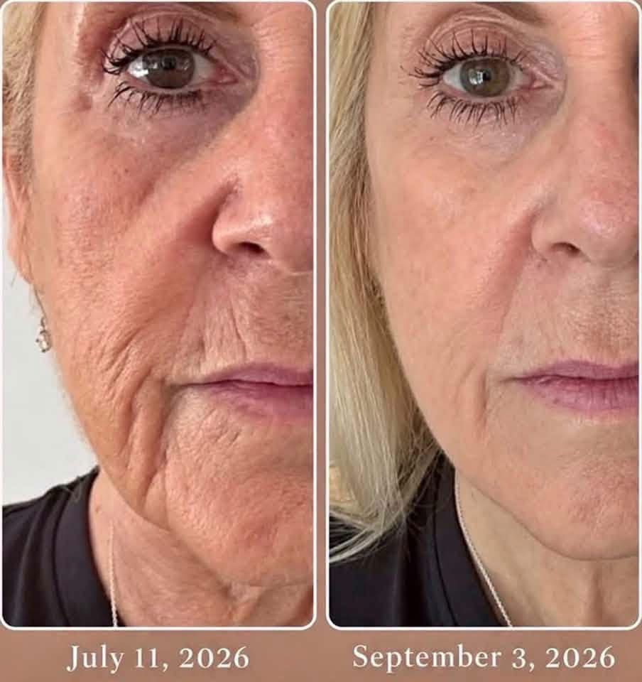 Perioral & Lower Cheek Deep Wrinkle Smoothing