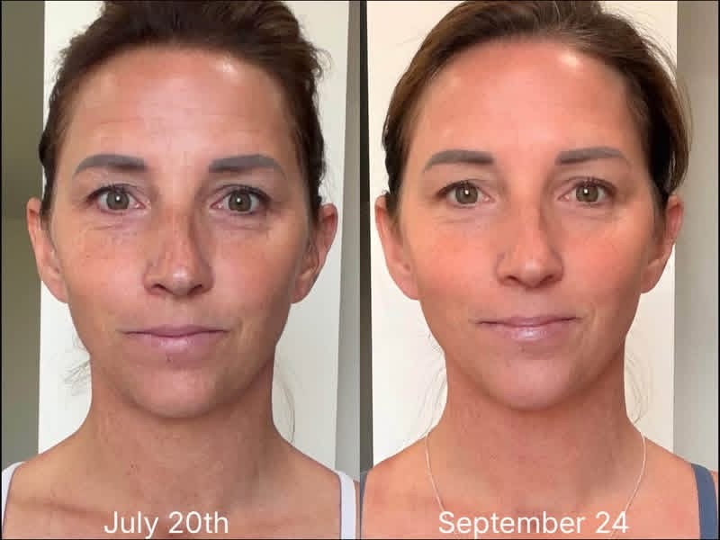 Midface Tone, Infraorbital Smoothing & Dermal Radiance