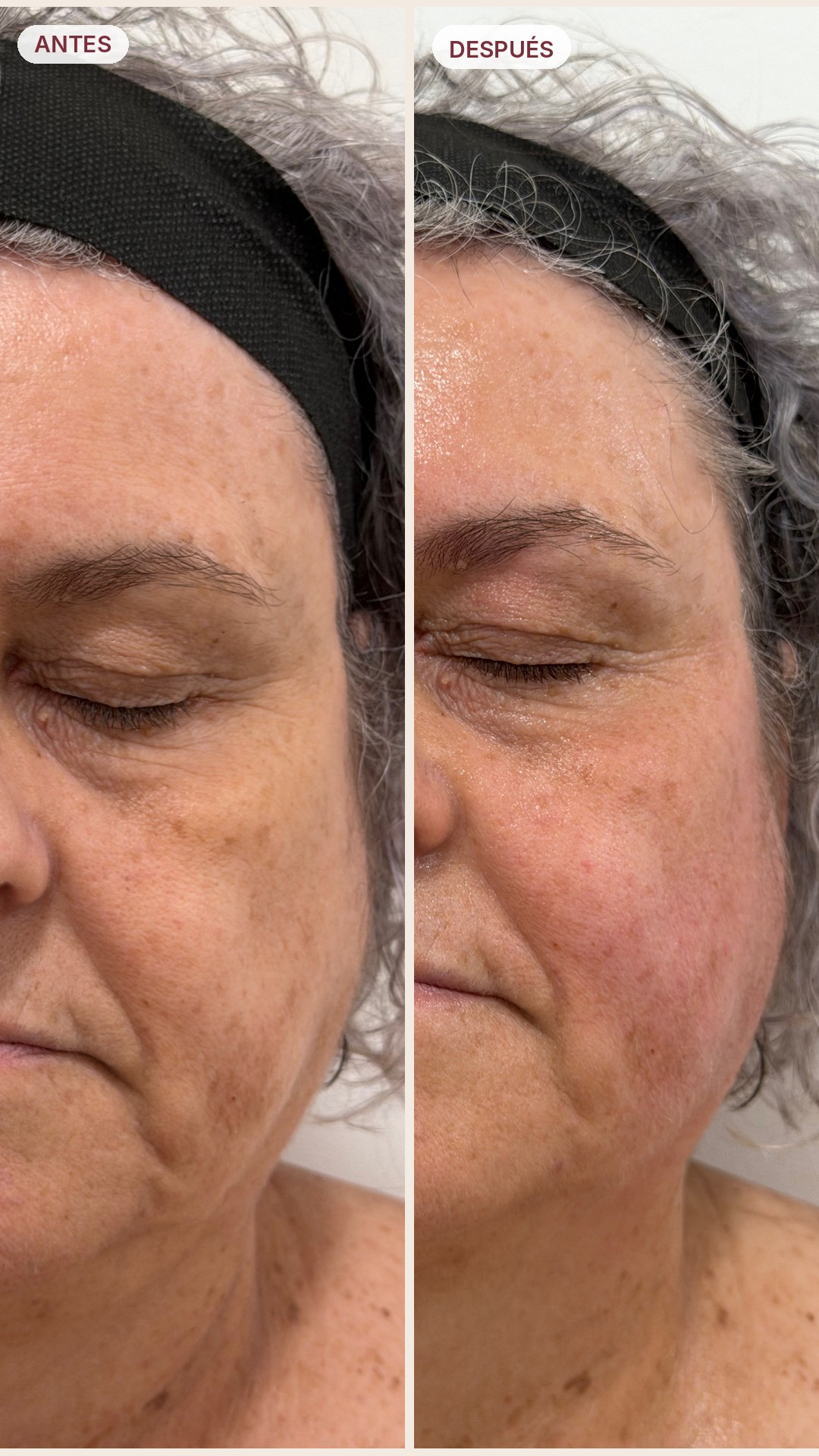 Resultado antes y después 3 - Revital 360