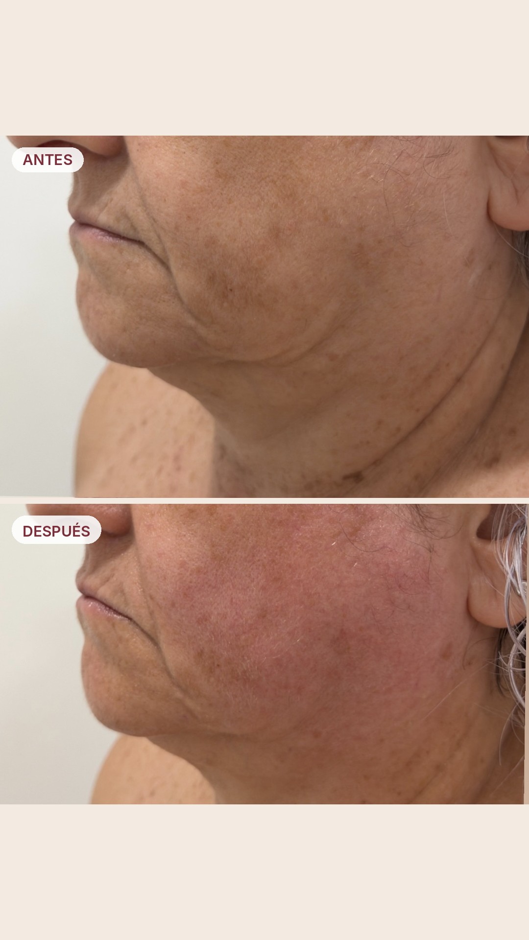 Resultado antes y después 1 - Revital 360