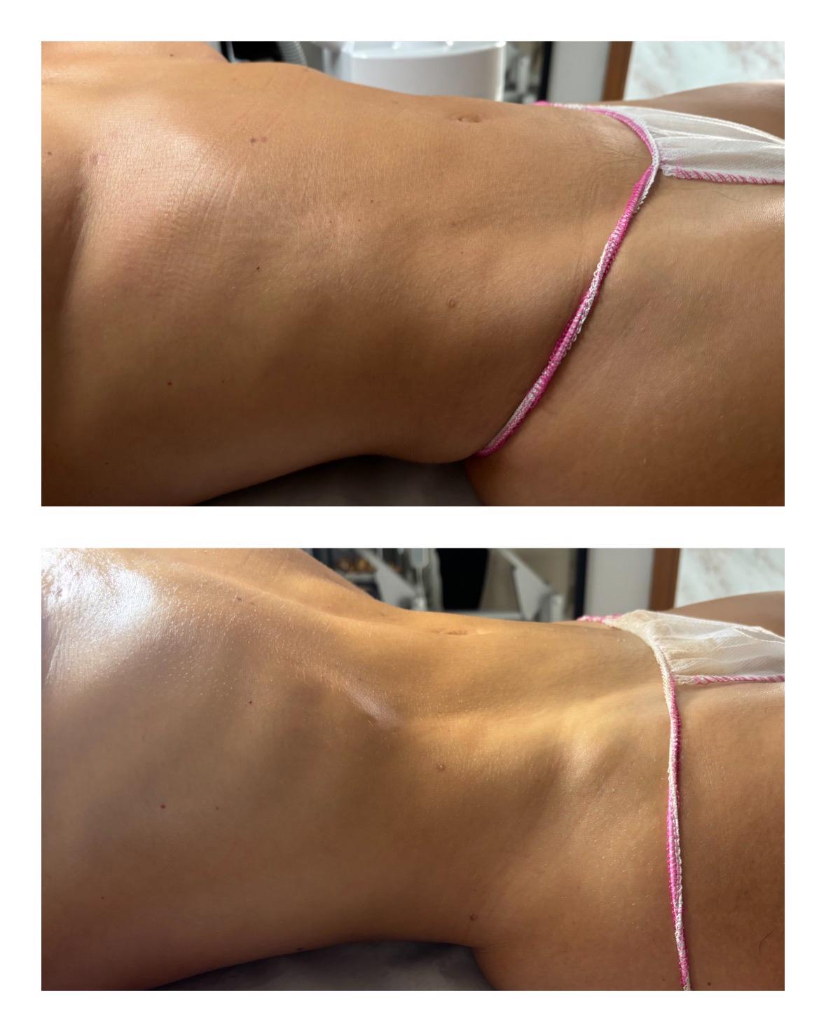 Comparativa de abdomen y cintura lateral antes y después en Magic Body