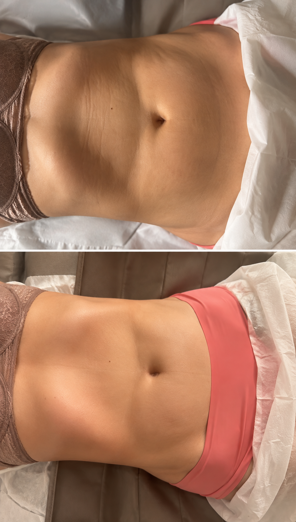 Comparativa de abdomen vista desde arriba antes y después en Magic Body