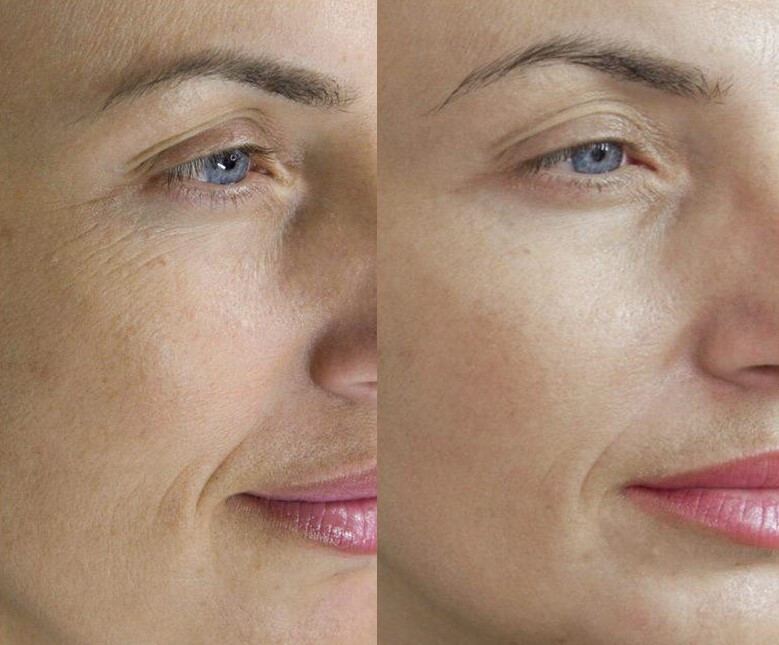 Skin booster rejuvenation and fine line smoothing results before and after at Pigment Lab