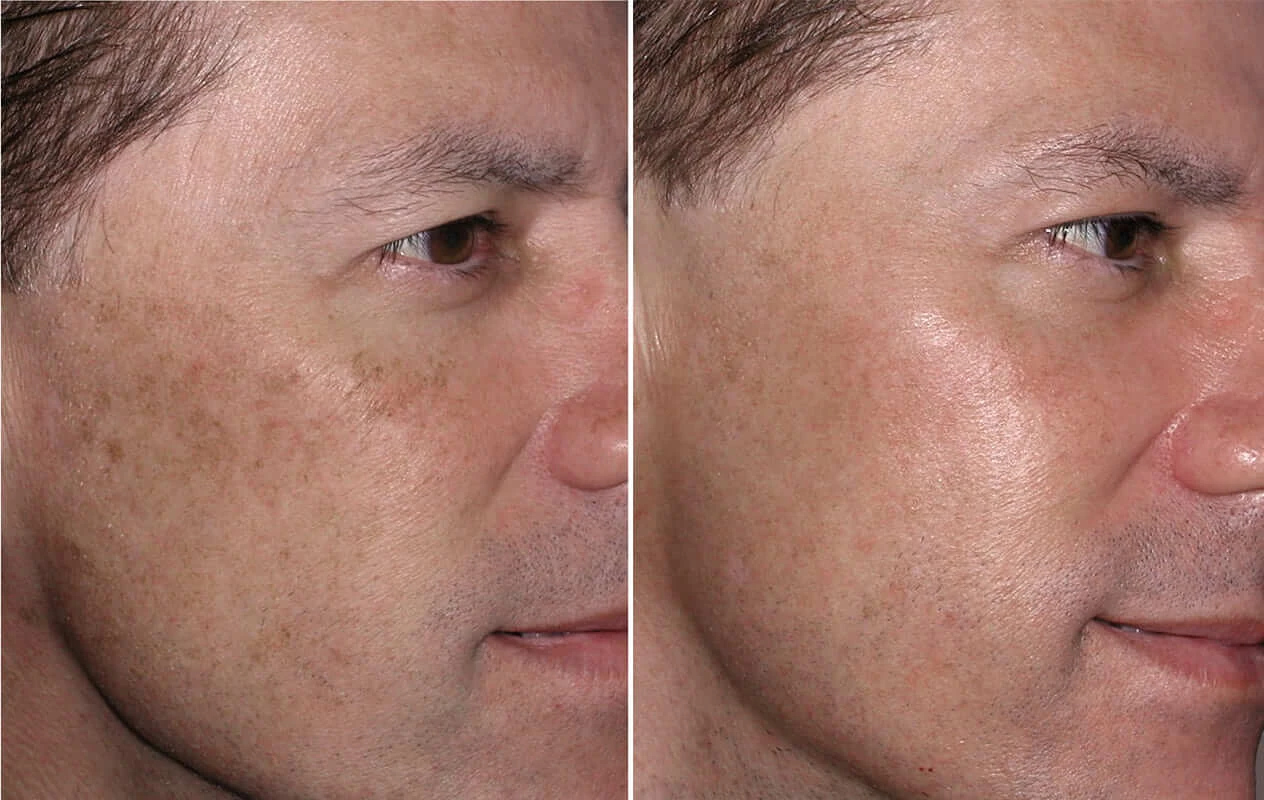 Chemical peel pigmentation and texture results before and after at Pigment Lab