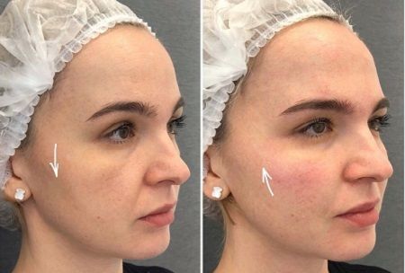 Dermal filler facial contouring and volume results before and after at Pigment Lab