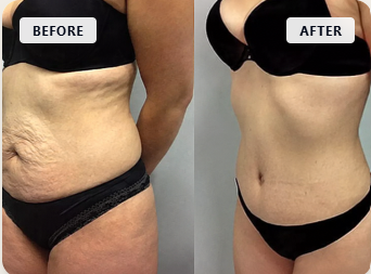 Before and after body sculpting result