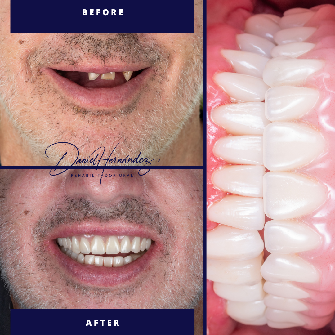 Full Arch Digital Rehabilitation - Before and After clinical results by Dr. Daniel Hernández