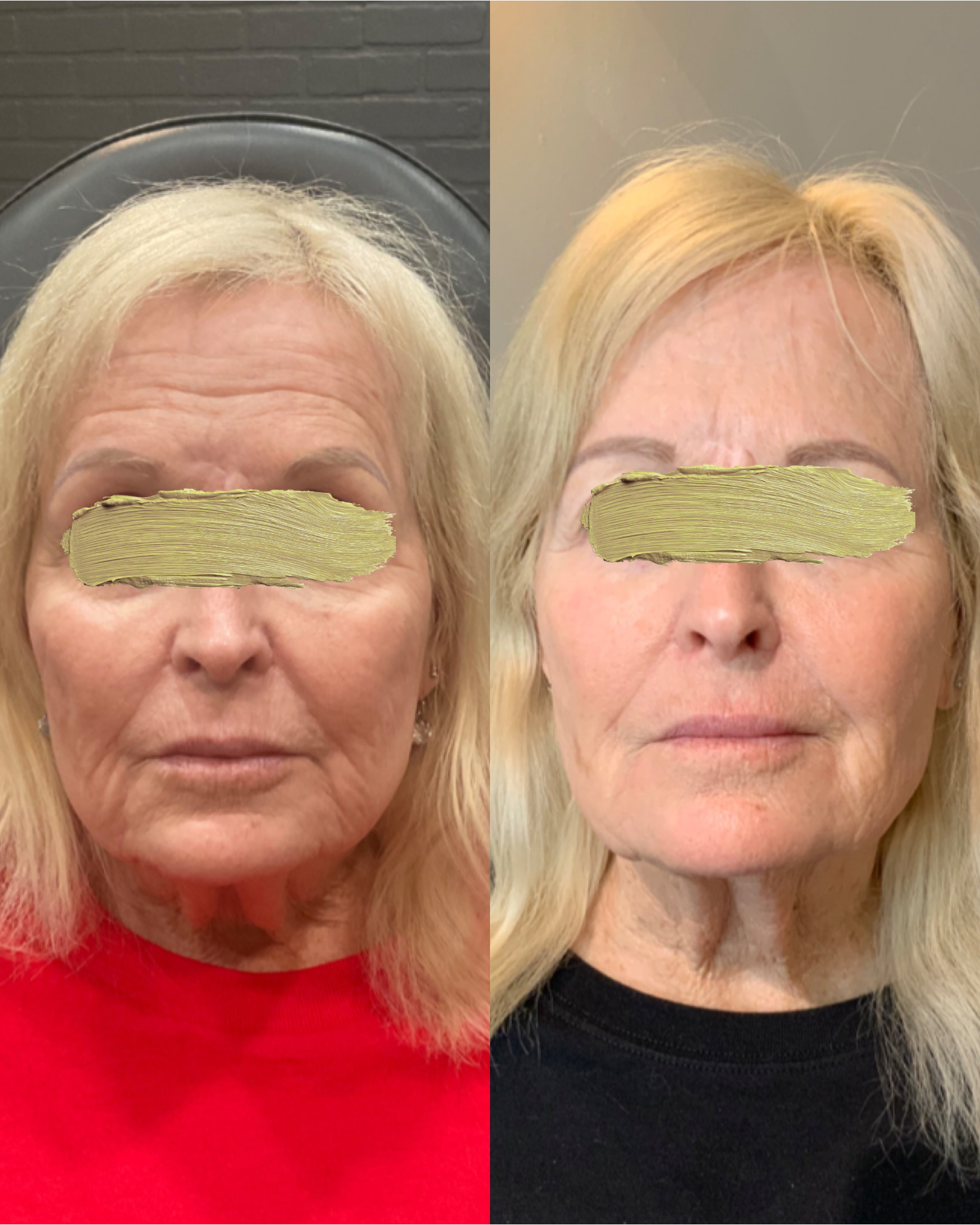 Skin Resurfacing