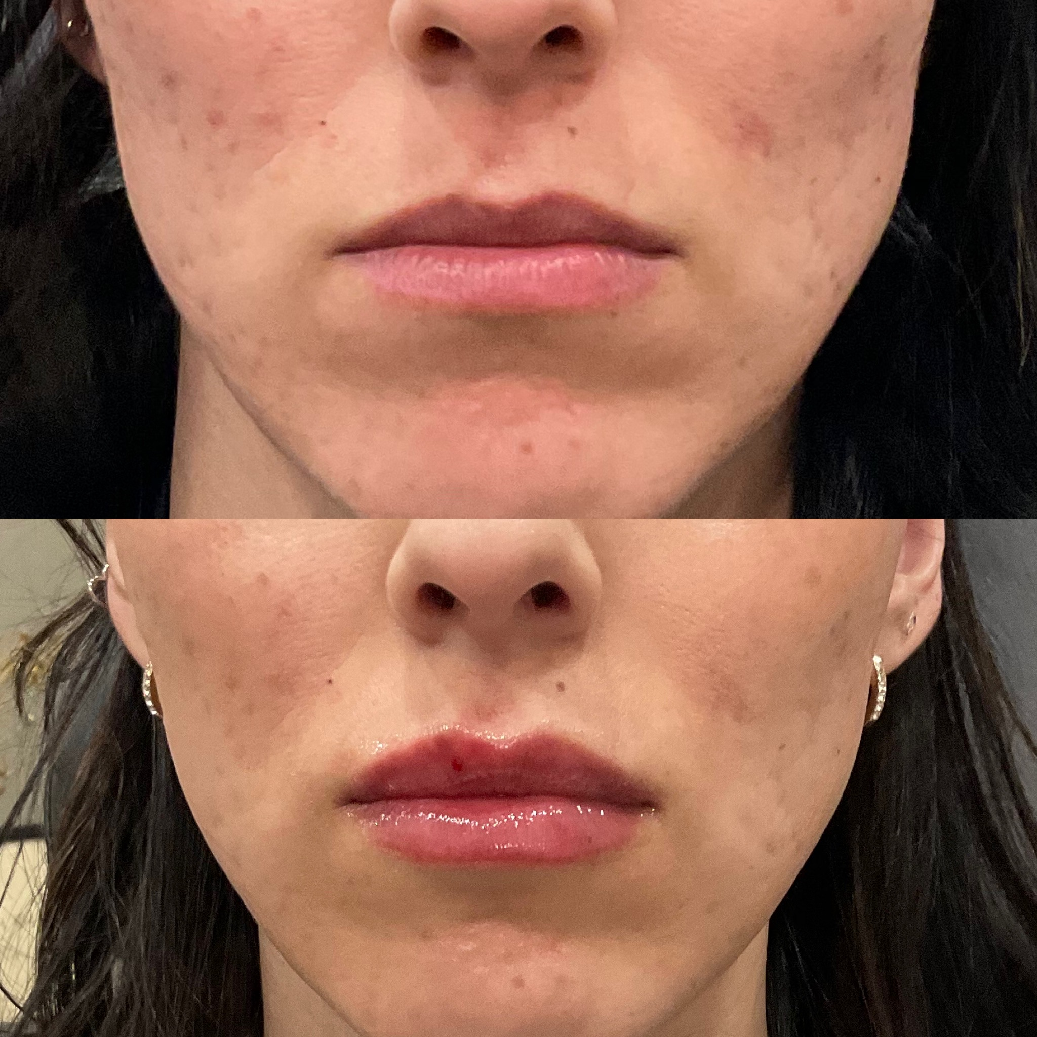 Lip Restoration