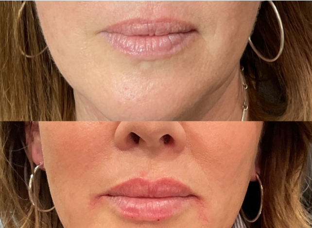 Lip & Perioral Refinement
