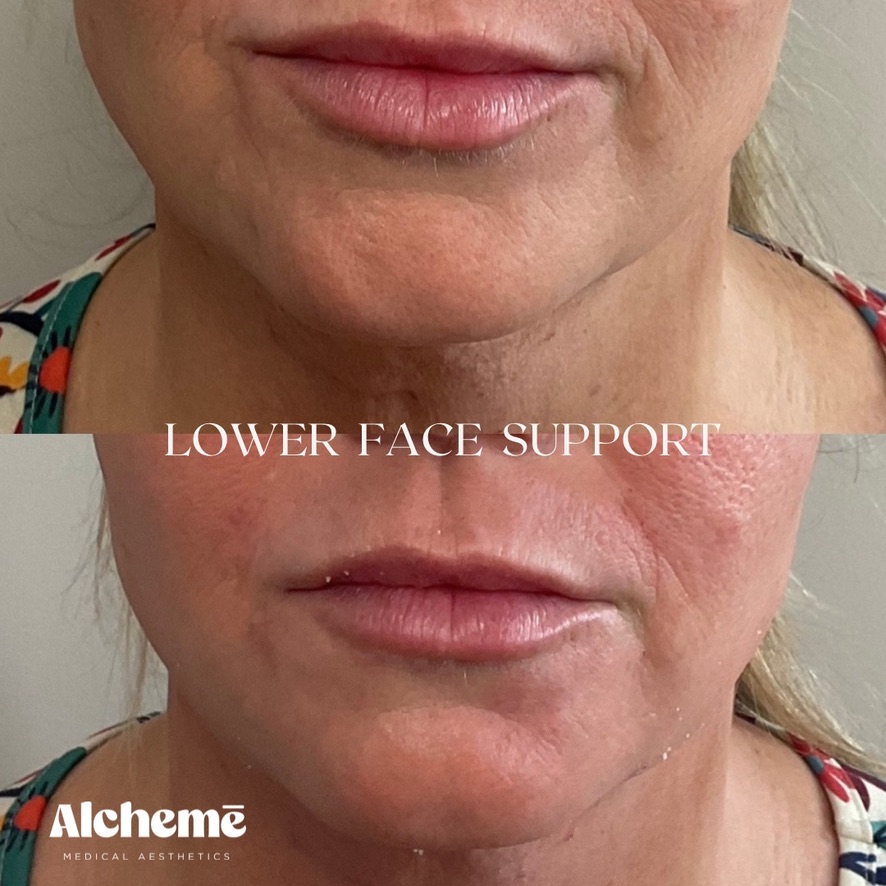 Lower Face Support & Jawline Balancing