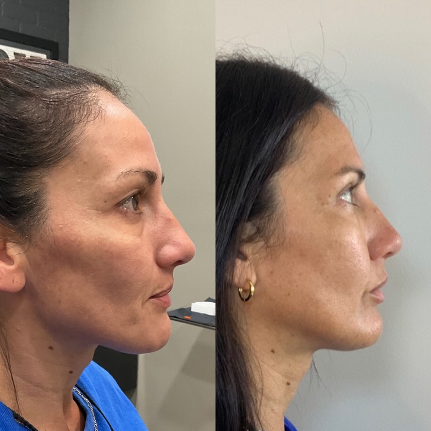 Dermal filler result 13