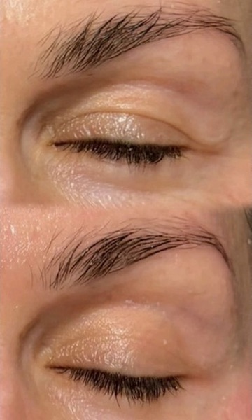 Dermal filler result 3