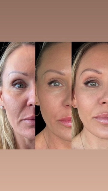 Dermal filler result 10