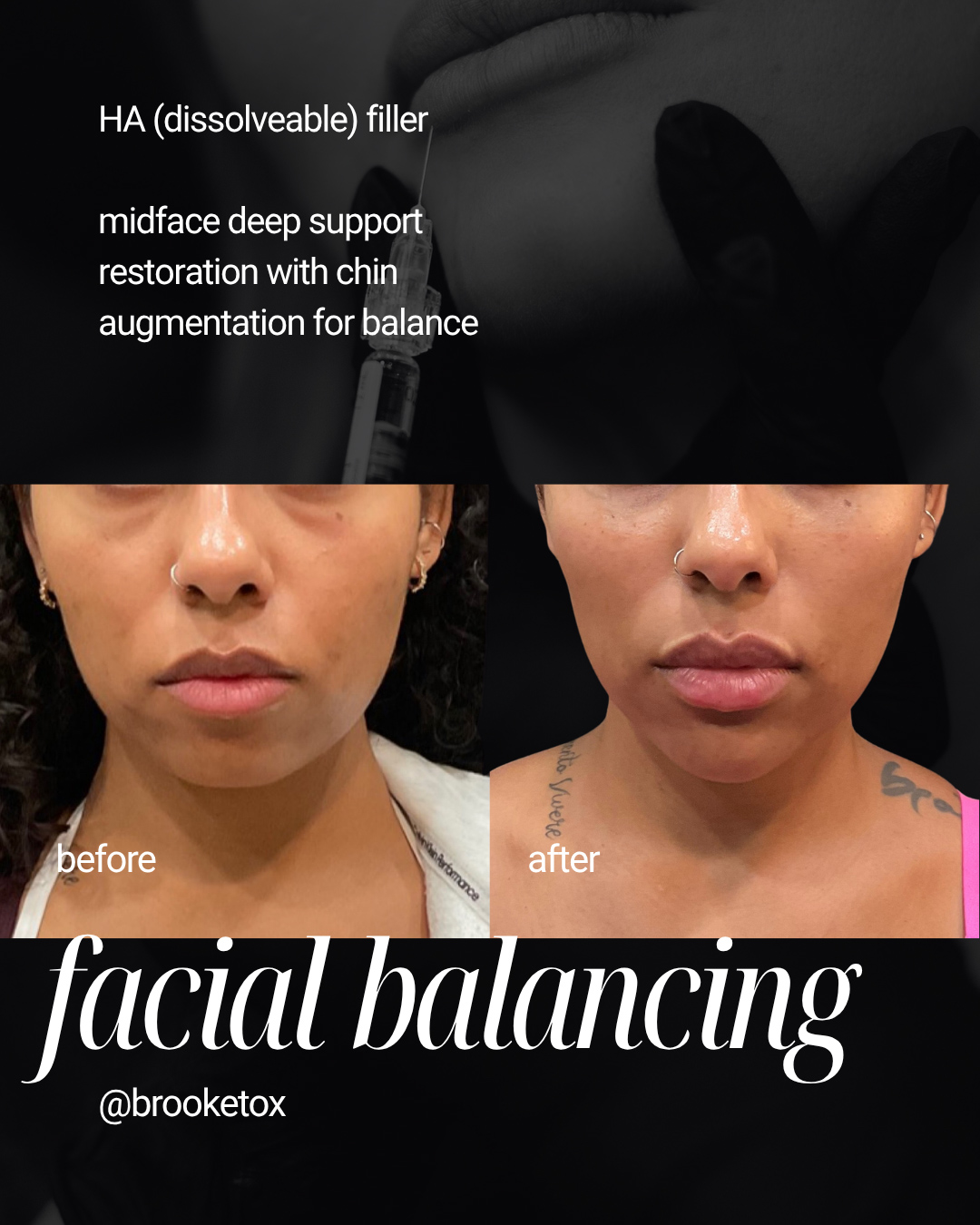 Facial Balancing & Midface Deep Support