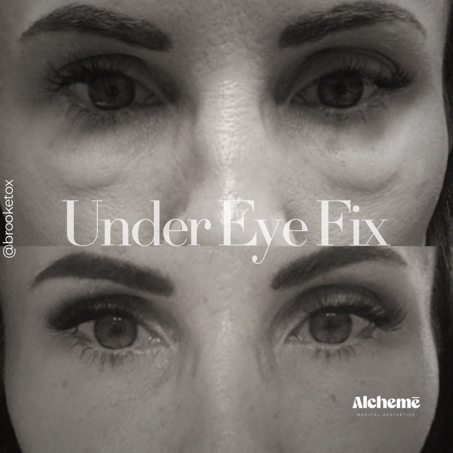 Under Eye Fix & Tear Trough Rejuvenation