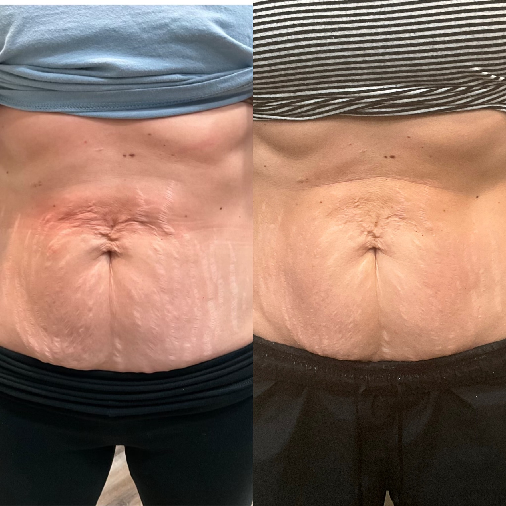 Dermal filler result 15