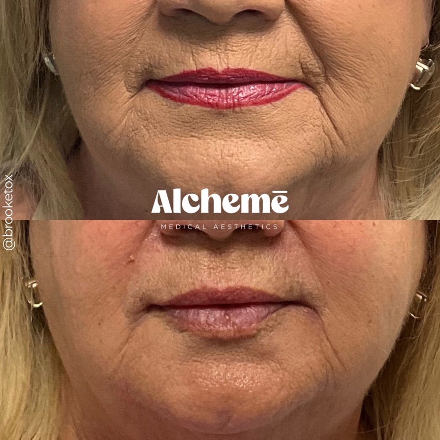Advanced Perioral Laser Resurfacing
