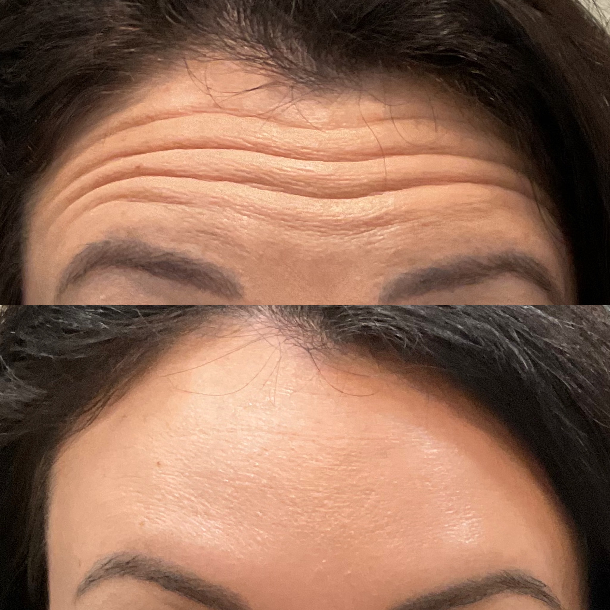 Forehead Line Smoothing & Wrinkle Relaxation