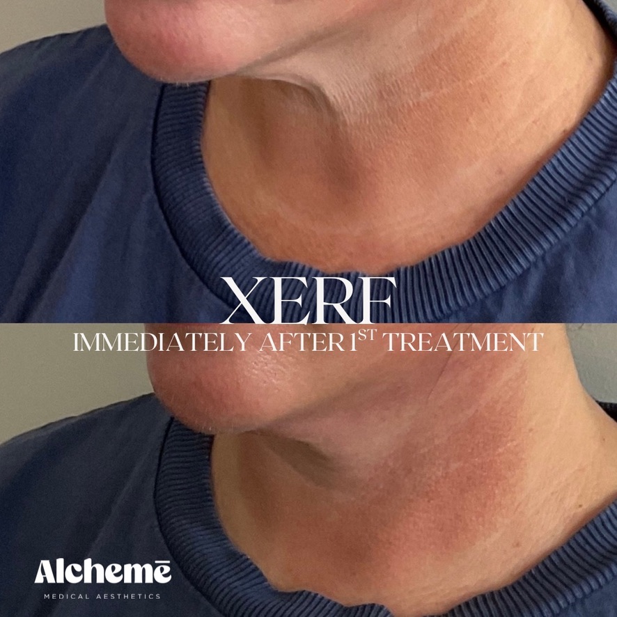 Dermal filler result 9