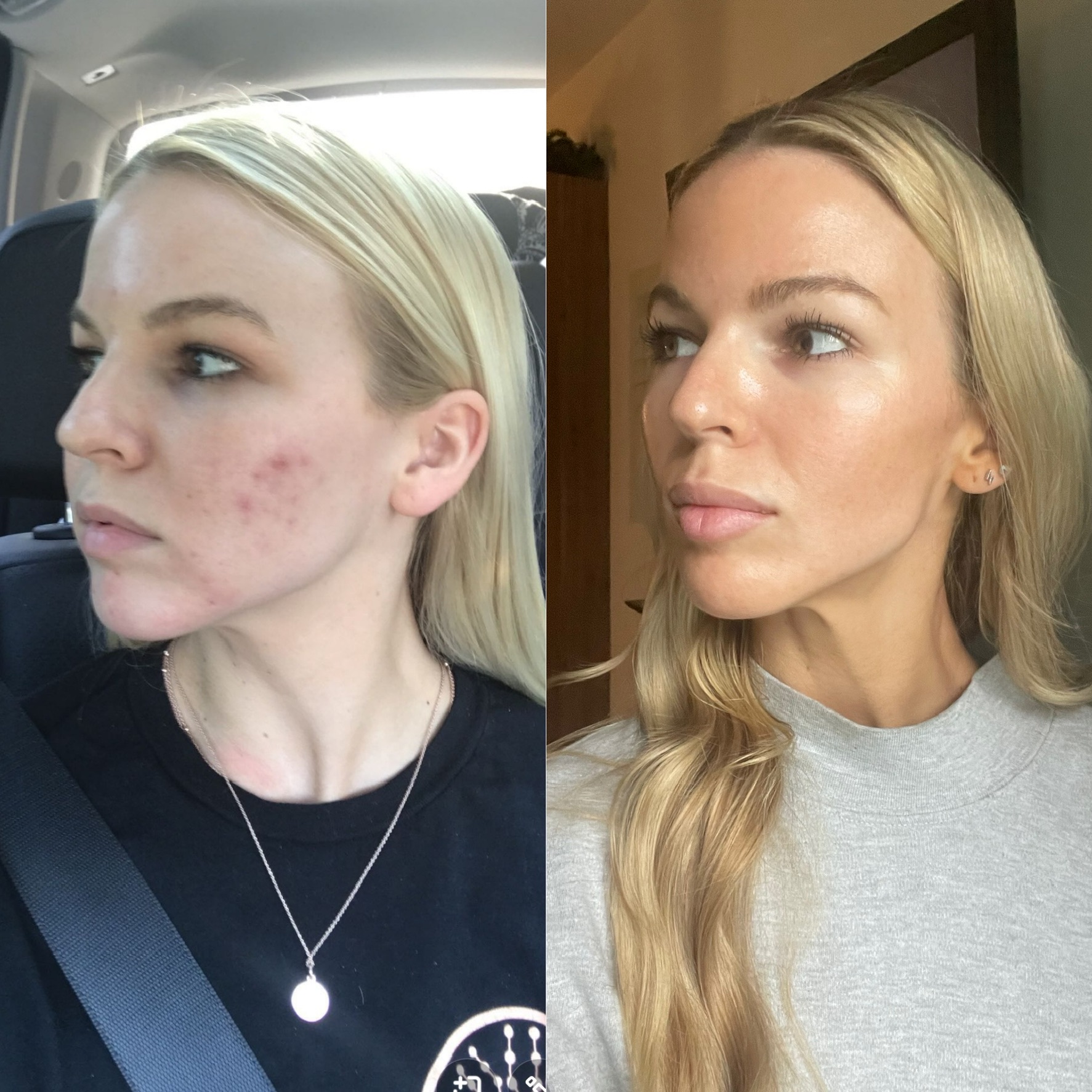 Skin Clarity & Complexion Transformation