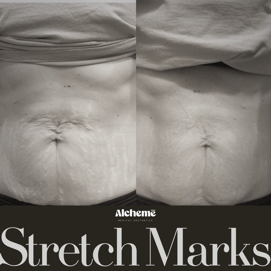 Abdominal Stretch Mark Texture Improvement